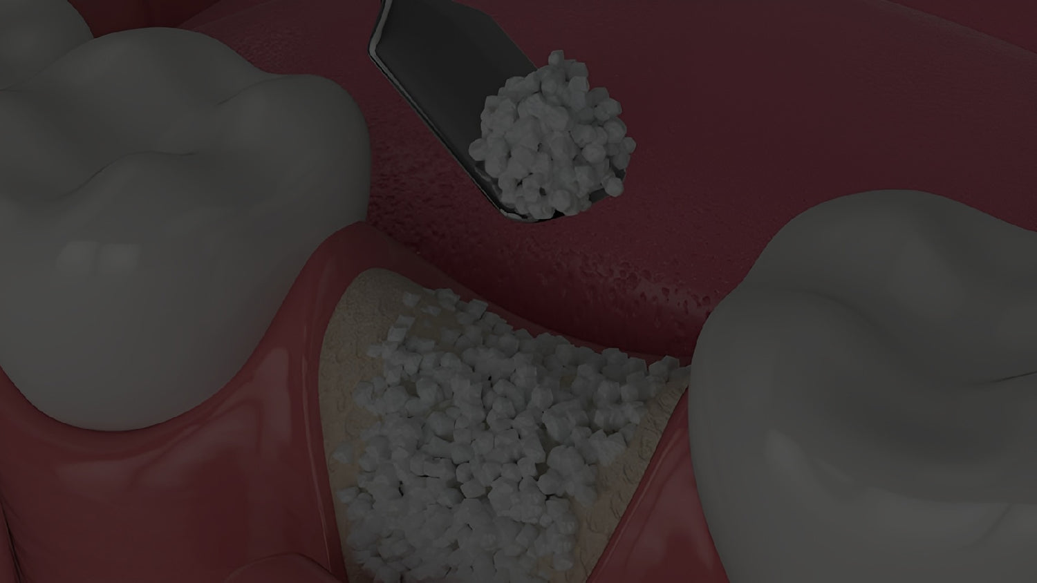 Bone Particulate